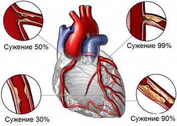 Ишемическая болезнь сердца, степень сужения сосудов.
