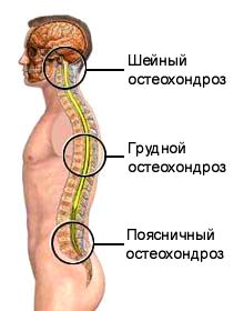 Виды остеохондроза: шейный остеохондроз, грудной остеохондроз, поясничный остеохондроз.