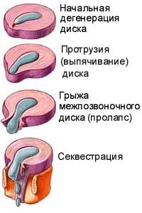 Остеохондроз: начальная дегенерация диска, протрузия (выпячивание) диска, грыжа диска (пролапс), секвестрация.